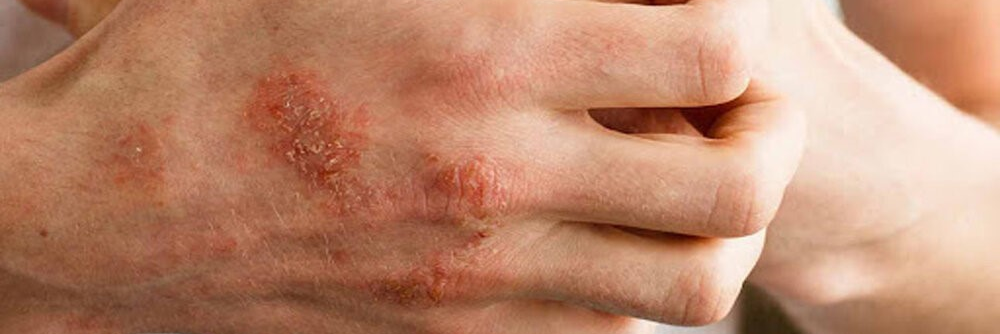  بهترین راهکار خانگی درمان سریع خارش پوست بدن